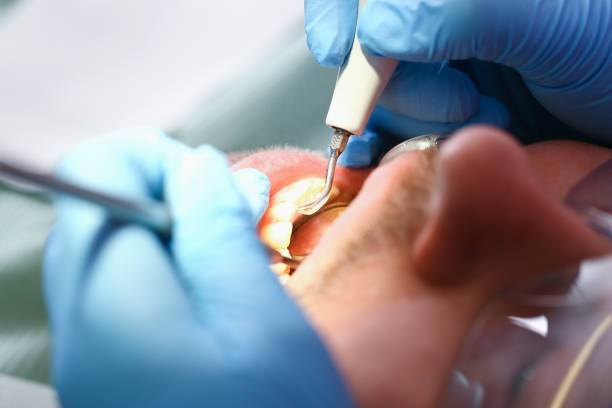 Best Emergency Dentist for Knocked-Out Tooth in Aberdeen, IN
