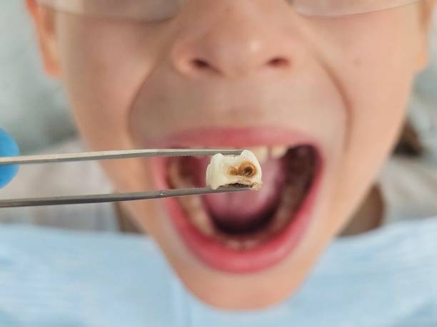 Best Emergency Dental Care for Abscessed Tooth in Aberdeen, IN